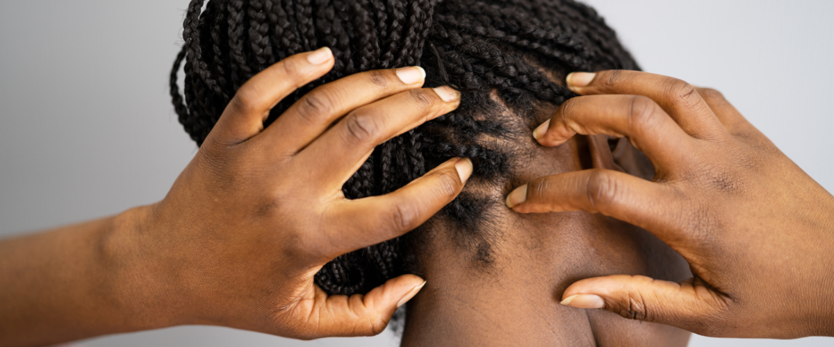 Alopecia